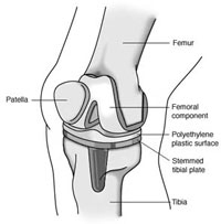 afi hip & knee replacement in noida