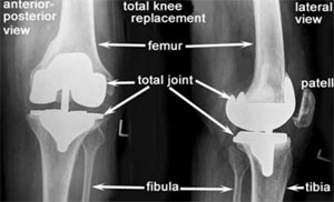 afi joint replacement best knee replacement surgeon in noida