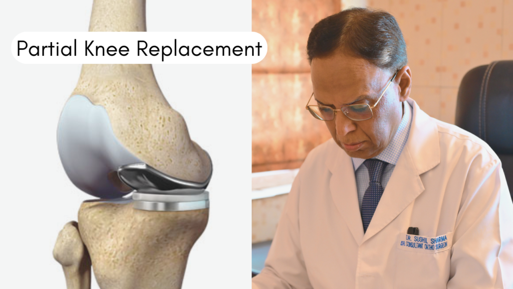 Partial vs Total Knee Replacement: Which One Do You Need?